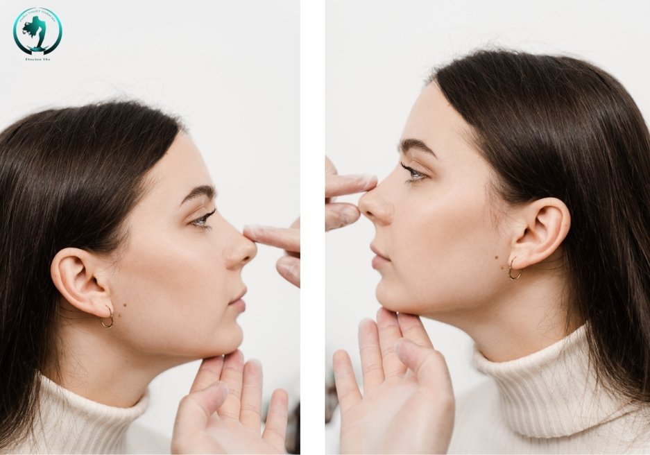 Nâng mũi bán cấu trúc