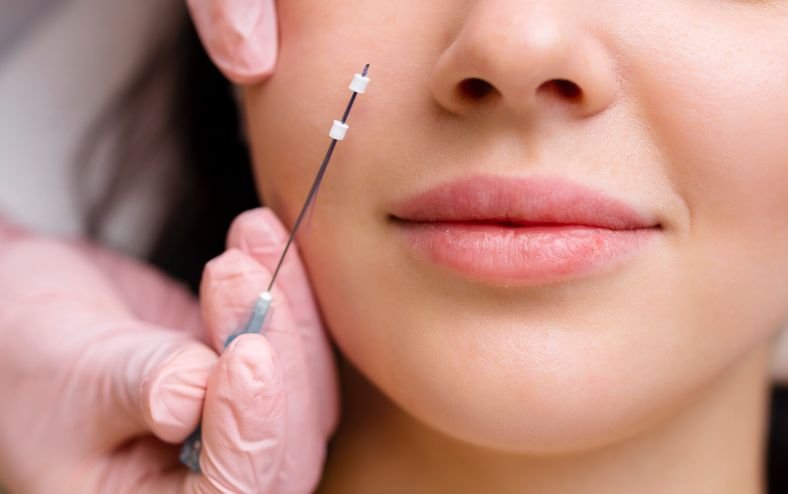 căng da mặt bằng chỉ collagen 