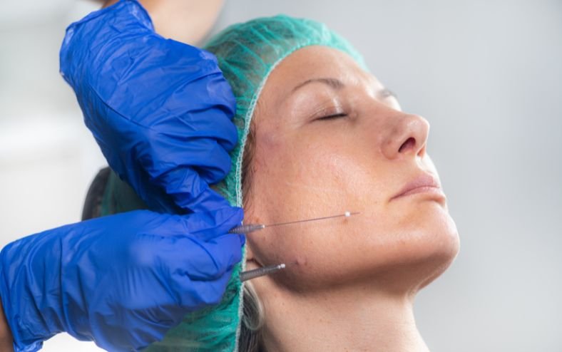 căng da mặt bằng chỉ collagen 